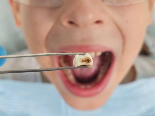 Best Broken or Chipped Tooth Repair in Doffing, TX
